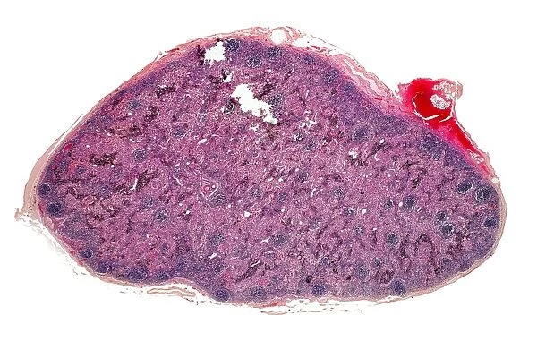 Inflamed lymph gland, light micrograph