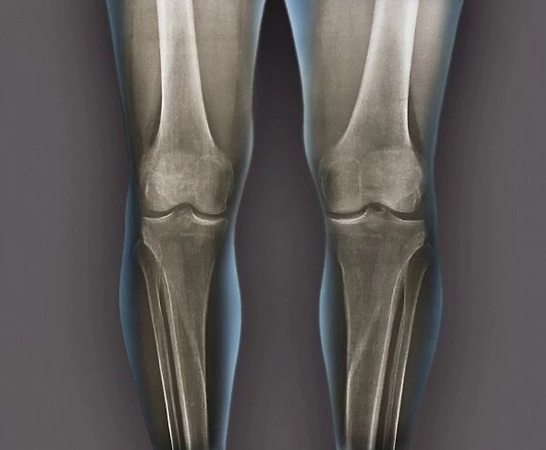 Normal knees, X-rays