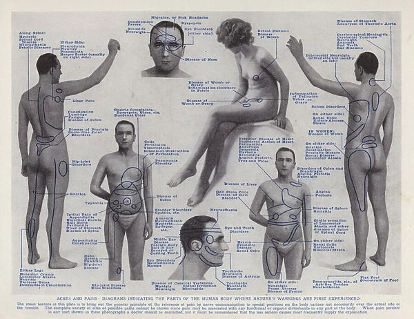Aches and Pains, Diagrams indicating the Parts of the Human Body where Natures Warnings are First Experiened (b  /  w photo)