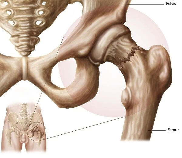 Anatomy of hip fracture