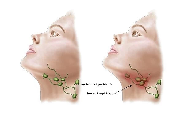 Anatomy of swollen lymph nodes