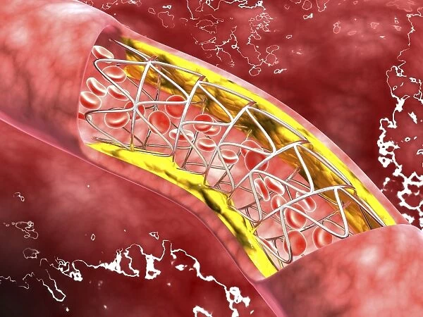 Artery cross-section with blood flow, fat plaque and stent deployment