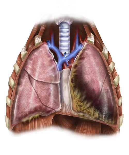 Artist depiction of mesothelioma in the lungs  /  abdominal cavity
