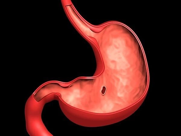 Conceptual image of peptic ulcer in human stomach