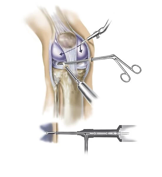 Detail of human knee showing insertion of arthroscopic instruments
