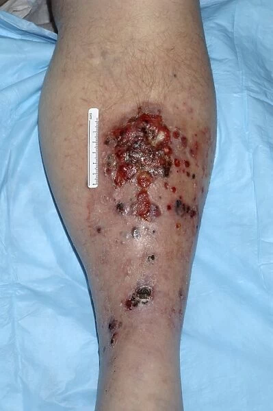 Large eroded plaque on the leg with areas of crust