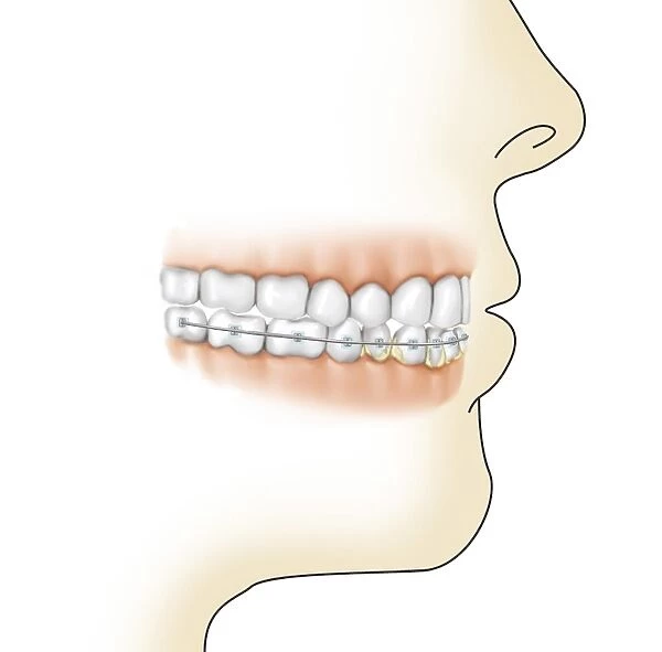 Lower gums with braces and plaque on teeth