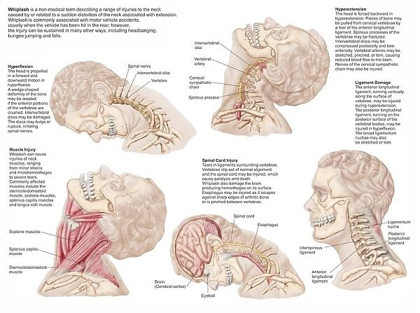 Medical chart showing the range of injuries to the human neck caused by whiplash