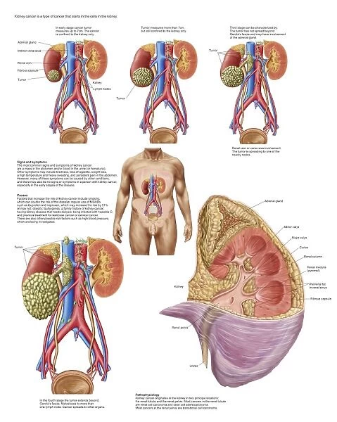 Medical chart showing the signs and symptoms of kidney cancer
