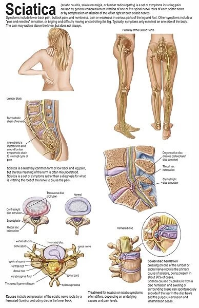Medical chart showing the signs and symptoms of sciatica