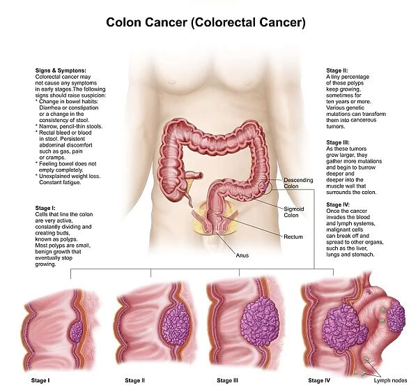 Medical illustration depicting the different stages of colon cancer