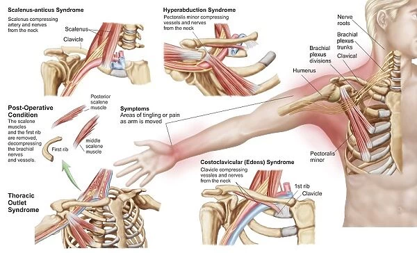 Medical illustration detailing thoracic outlet syndrome