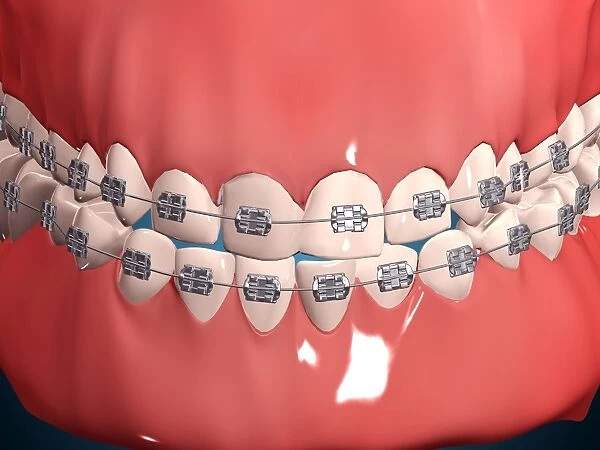 Medical illustration of human mouth showing teeth, gums and metal braces