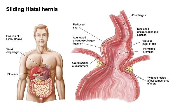 Medical ilustration of a hiatal hernia in the upper part of the stomach into the thorax