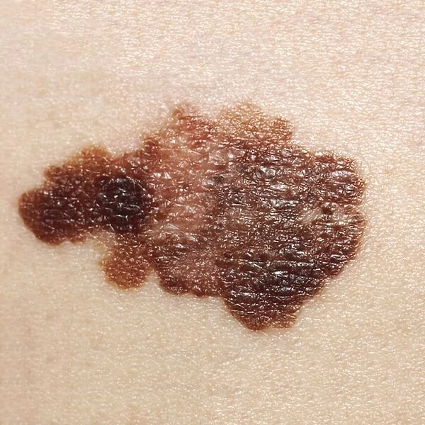 Melanoma on a patients skin