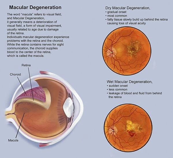 Retina with macular degeneration