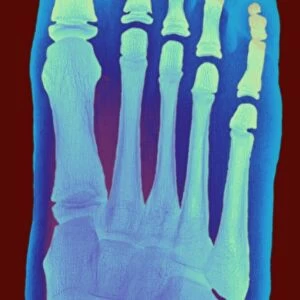 Childs foot, X-ray