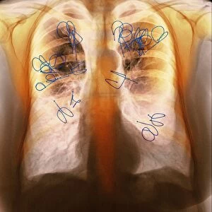 Endobronchial valves, X-ray F008 / 3471
