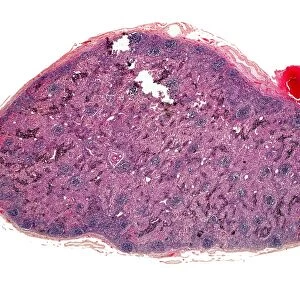 Inflamed lymph gland, light micrograph