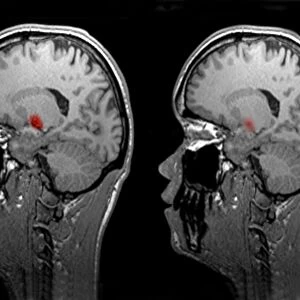 Jealousy, conceptual MRI brain scans C016 / 9634