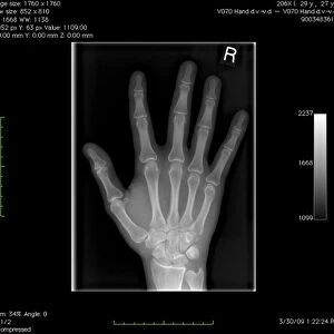 Normal hand, digital X-ray