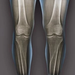Normal knees, X-rays