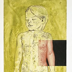 Dermatitis, Infantile seborrheic eczema, drawing