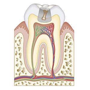 Cross section biomedical illustration of tooth decay before dental filling