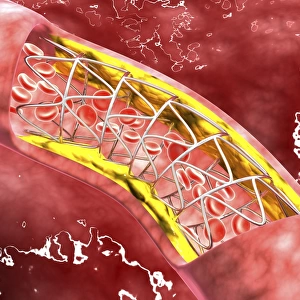 Artery cross-section with blood flow, fat plaque and stent deployment