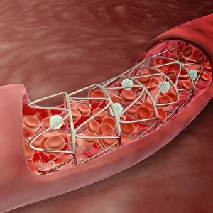 Artery cross-section with blood flow and stent deployment