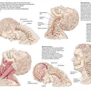 Medical chart showing the range of injuries to the human neck caused by whiplash