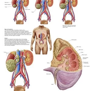 Medical chart showing the signs and symptoms of kidney cancer