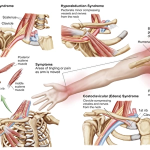 Medical illustration detailing thoracic outlet syndrome