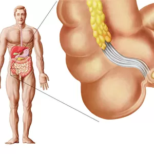 Medical ilustration of an appendix with appendicitis