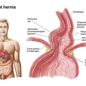 Medical ilustration of a hiatal hernia in the upper part of the stomach into the thorax