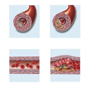Normal artery compared to plaque and thrombus formation in artery