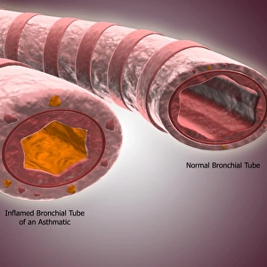 Trachea cross-section showing normal and asthmatic bronchiole