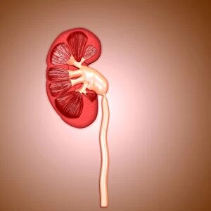Ureteropelvic junction (UPJ) obstruction in the kidney